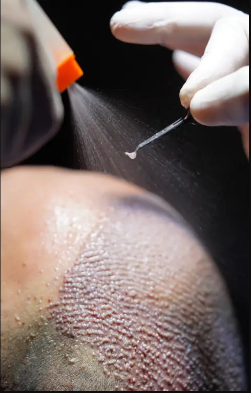 Hair Transplant